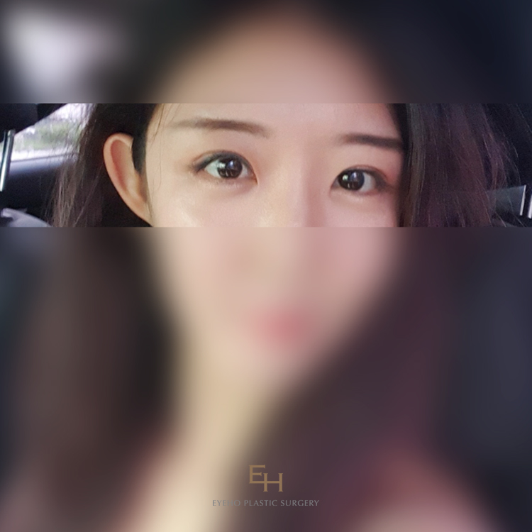 눈매교정가격 알아보고 있다면 관련 이미지 1