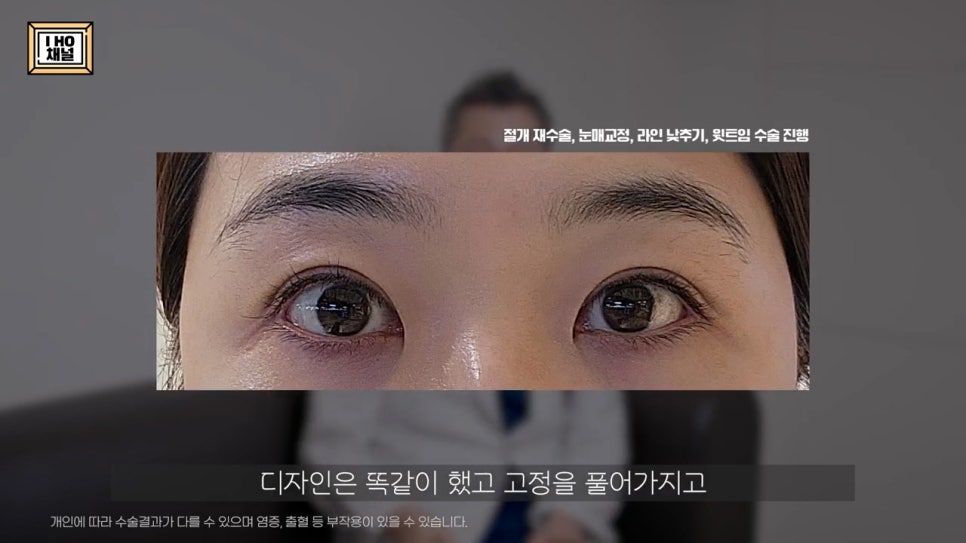 소세지눈 다 같은 게 아니다!? 유형별 재수술 방법에 대해 알려드리겠습니다. 관련 이미지 57