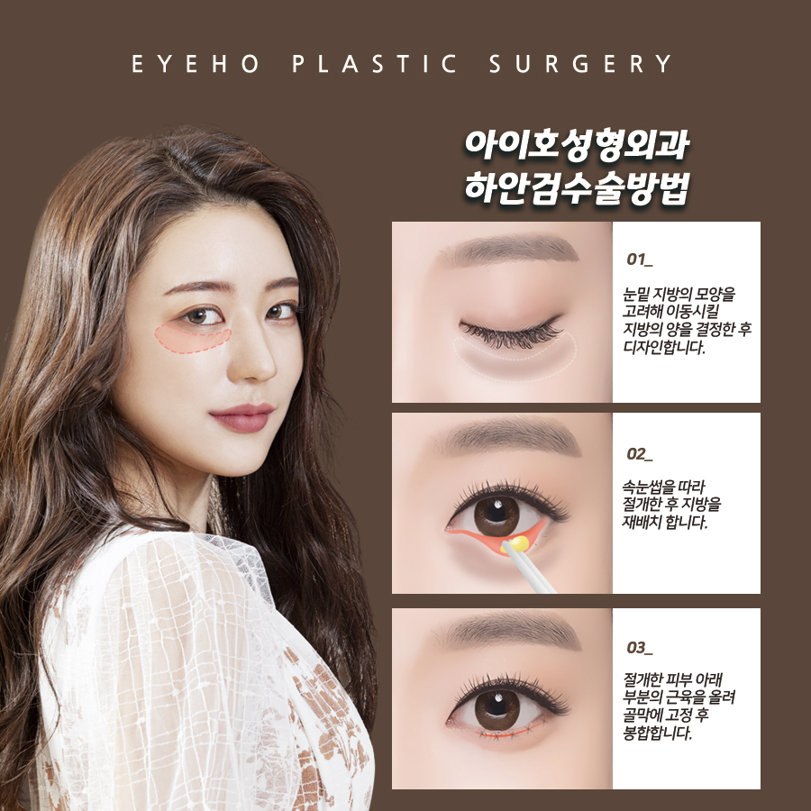 하안검 수술 / 하안검 수술 후기 및 하안검 수술비용 그리고 부작용 관련 이미지 3