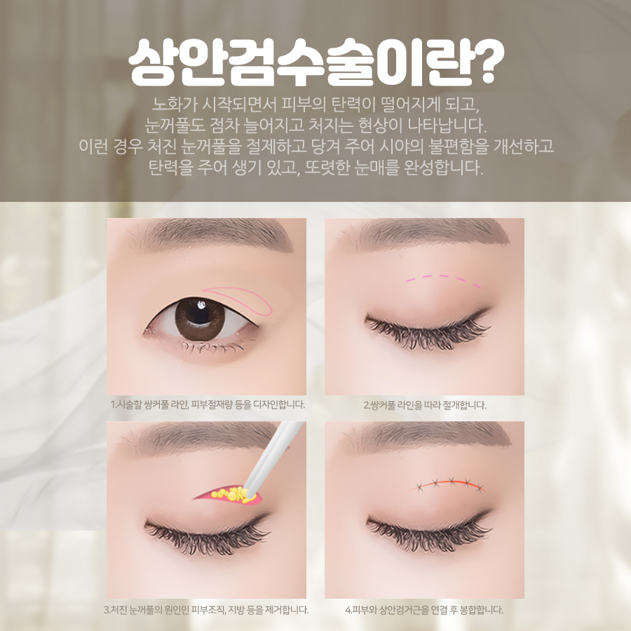 중년눈성형 종류 나에게 맞는 올바른 수술 방법 관련 이미지 3