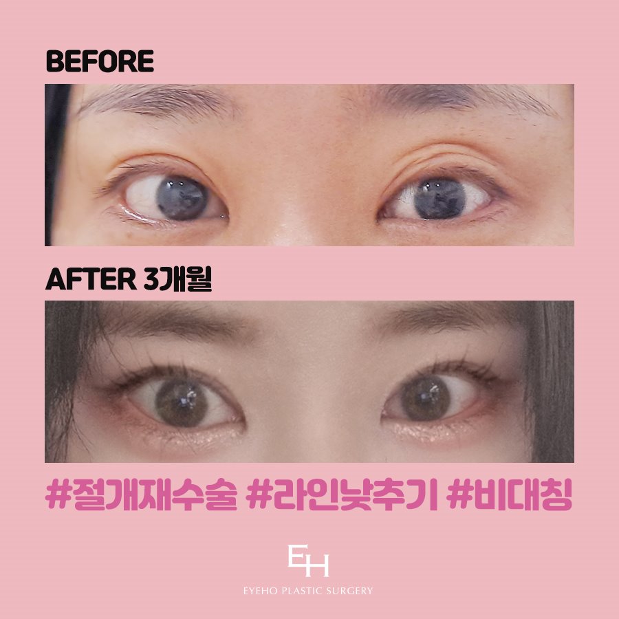 쌍꺼풀재수술비용 마지막이 되도록 관련 이미지 5