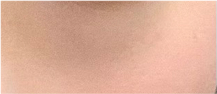 눈재수술비용 어떨때 개선해야 하나요? 관련 이미지 24