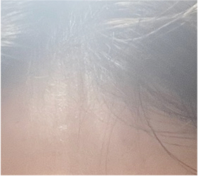남자 눈매교정 가격 및 남자 눈매교정 전후 차이 비교 분석 관련 이미지 18