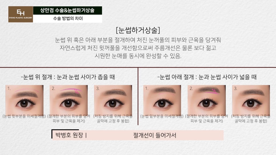 처진눈 상안검? 눈썹하거상술? 궁금하시다면 들어와!! 관련 이미지 25