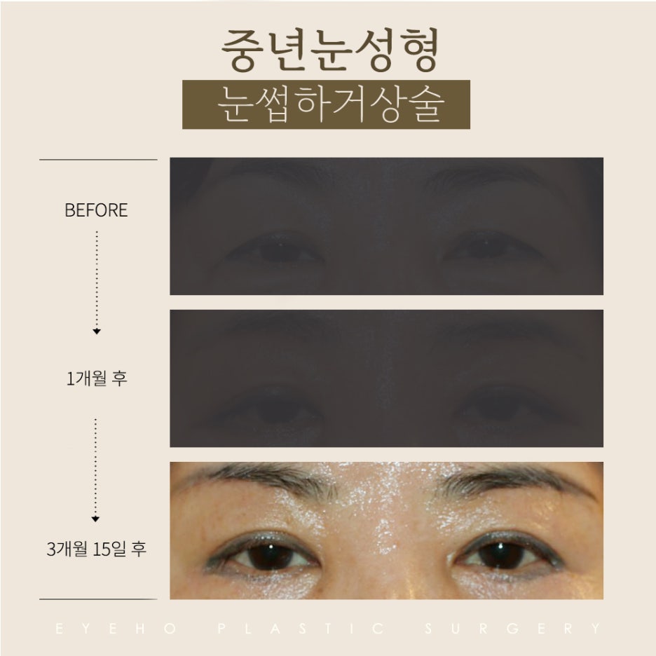 Brow Lift Cost and Brow Lift Review, Pain, and Precautions image 4