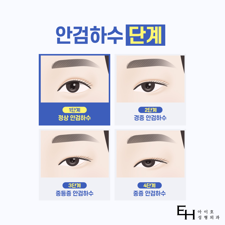 안검하수눈매교정 눈 처짐 고민된다면 관련 이미지 3