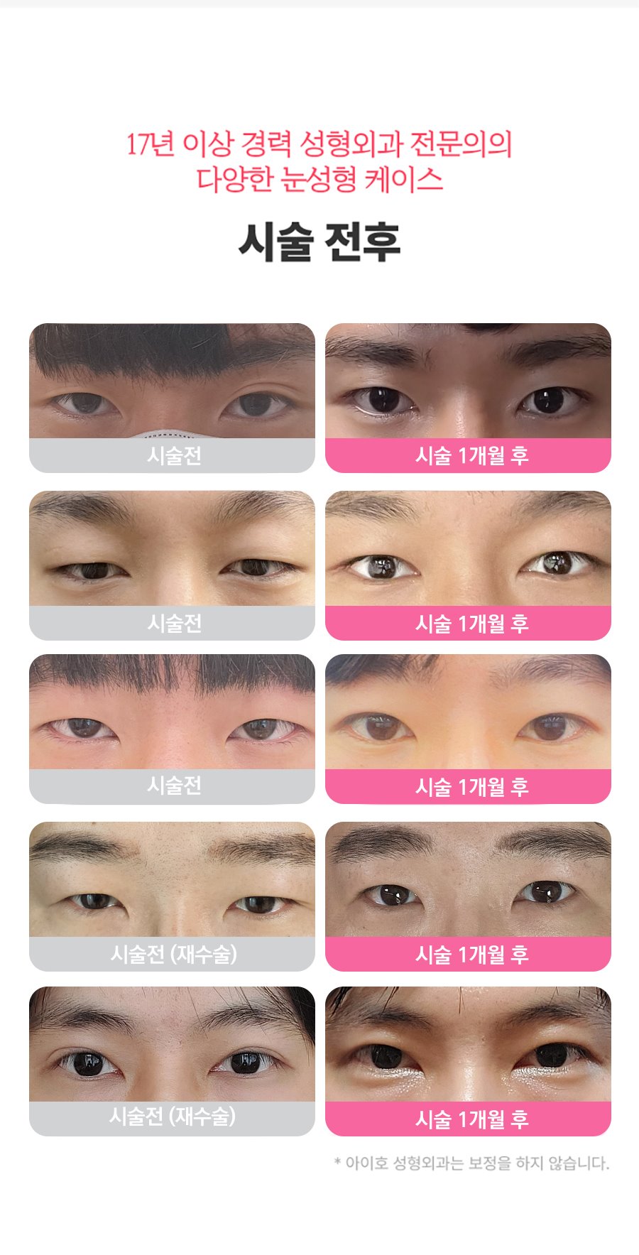 남자 눈매교정 가격 및 남자 눈매교정 전후 차이 비교 분석 관련 이미지 5