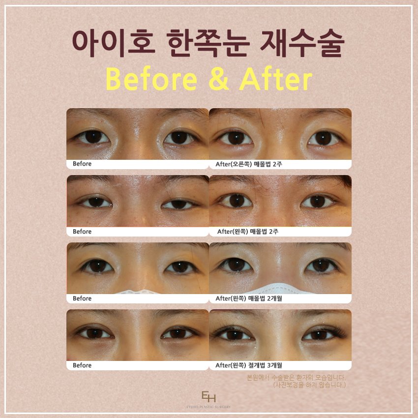 비대칭 짝눈교정 한쪽눈성형으로 대칭을 이루세요. 관련 이미지 5