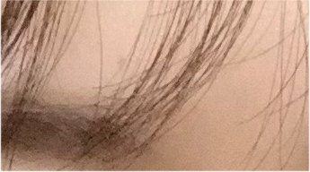 눈재수술비용 어떨때 개선해야 하나요? 관련 이미지 17