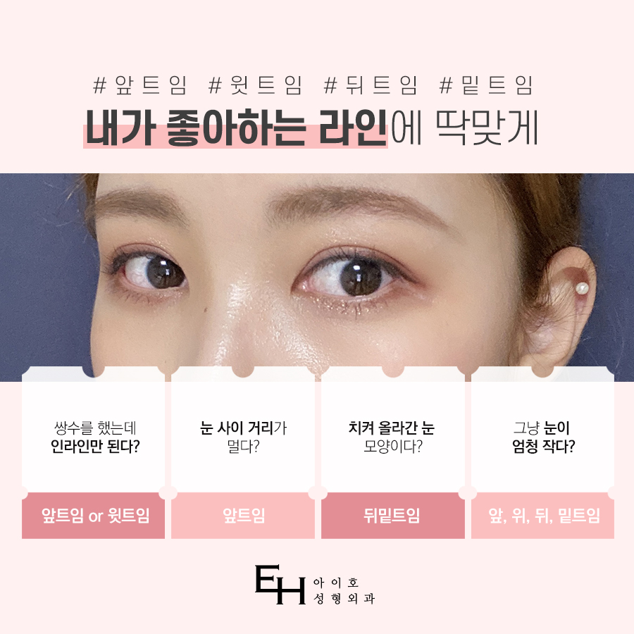 꼬막눈쌍수 시원하게 개선하려면 관련 이미지 4