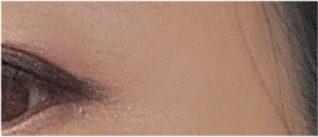 Brow Lift Cost and Brow Lift Review, Pain, and Precautions image 24