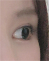 소세지눈재수술 붓기가 고민이라면 관련 이미지 22