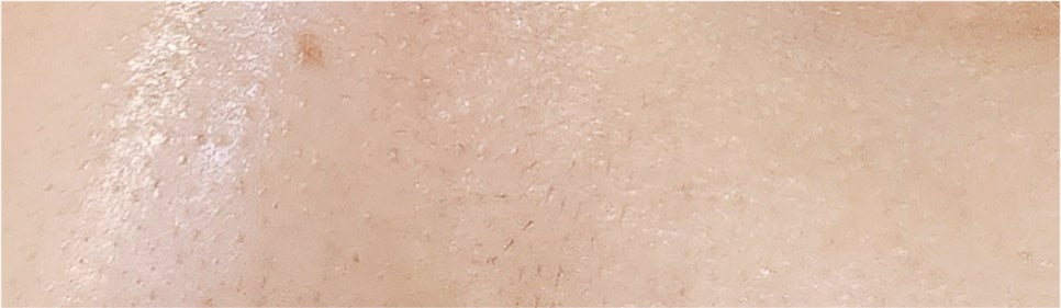 Effectively Achieving a Natural Look with Male Eye Surgery image 22