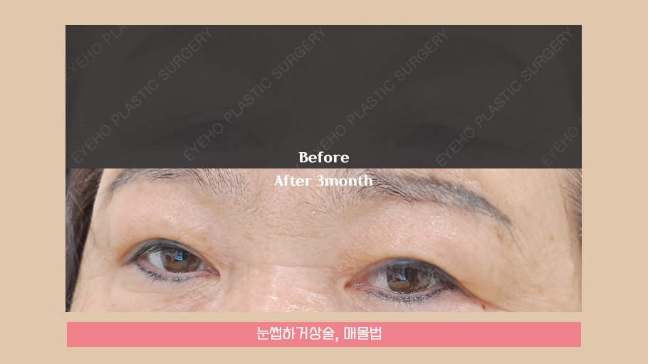 Brow Lift Review: Droopy Eye Surgery & Brow Lift Methods / Brow Lift Scars image 14