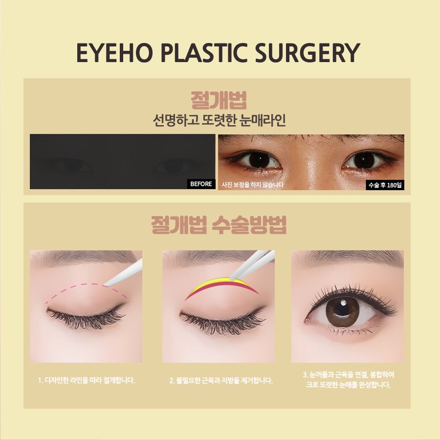 눈성형잘하는곳 아이호성형외과 관련 이미지 4