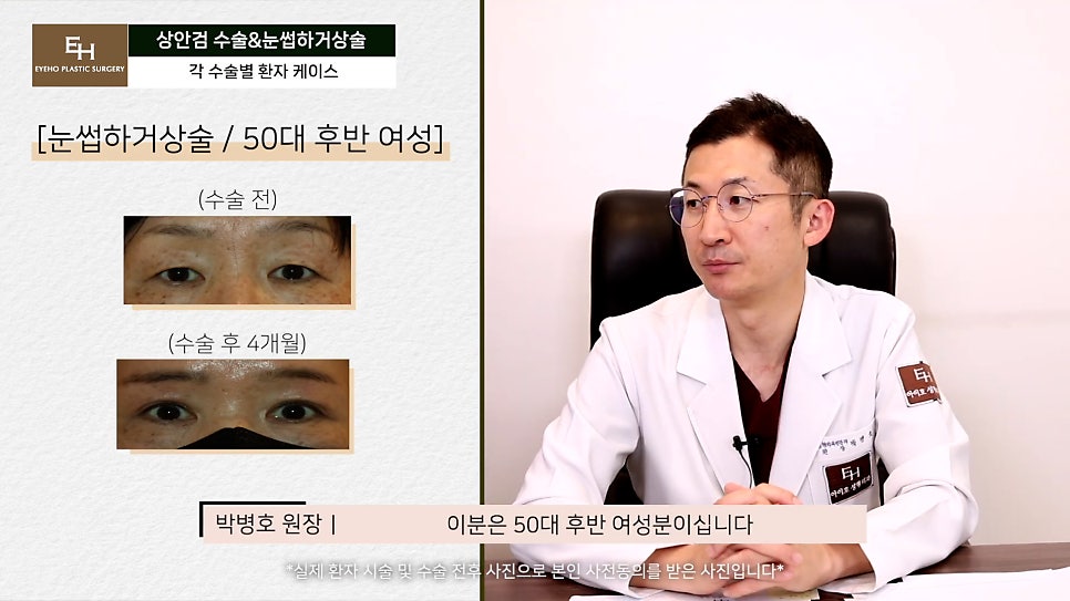 처진눈 상안검? 눈썹하거상술? 궁금하시다면 들어와!! 관련 이미지 34