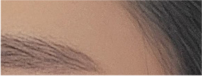 Brow Lift Cost and Brow Lift Review, Pain, and Precautions image 21