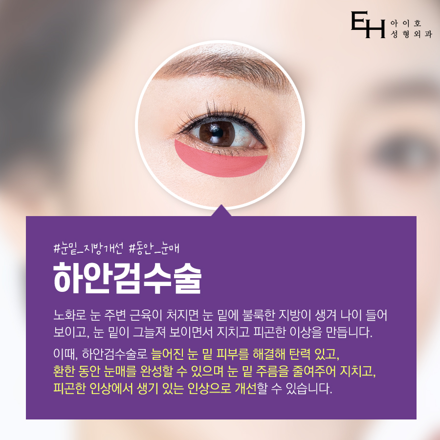 하안검수술 : 눈밑처짐수술 / 하안검 수술 후기, 비용, 회복기간, 부작용 관련 이미지 3