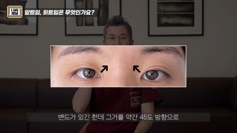 앞트임, 윗트임 하지 말아야할 눈!! 관련 이미지 9