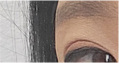 Brow Lift Cost and Brow Lift Review, Pain, and Precautions image 22