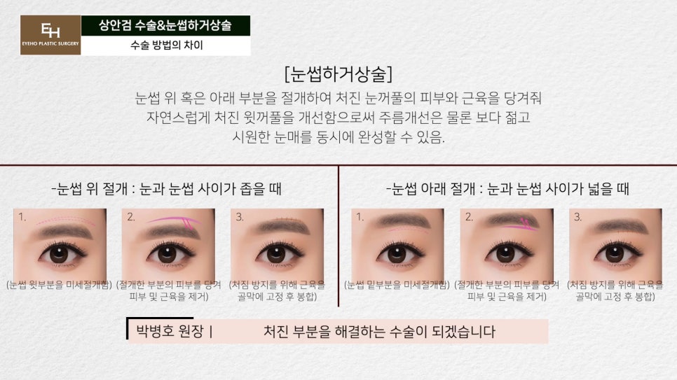 처진눈 상안검? 눈썹하거상술? 궁금하시다면 들어와!! 관련 이미지 27