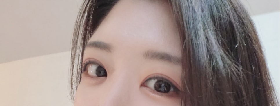 Double Eyelid Revision Surgery Review _ Comparison of Eye Revision Methods and 7-Day Double Eyelid Revision Surgery Review image 15