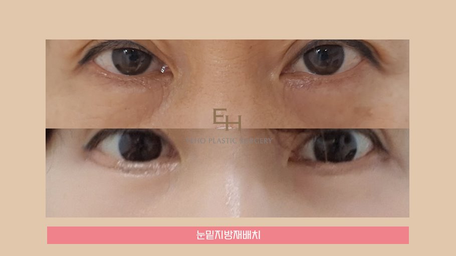 하안검 수술 후기 / 눈밑처짐수술 회복기간 관련 이미지 4