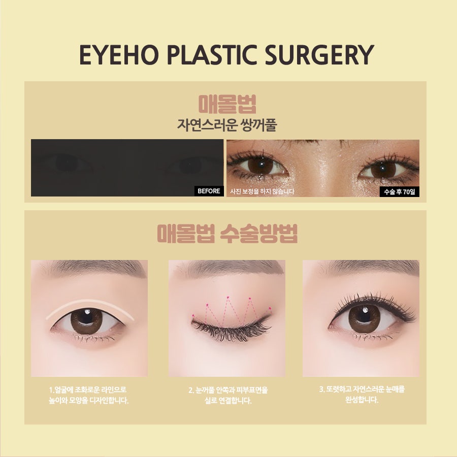 눈성형잘하는곳 아이호성형외과 관련 이미지 3