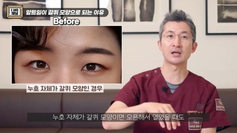 앞트임, 윗트임 하지 말아야할 눈!! 관련 이미지 41