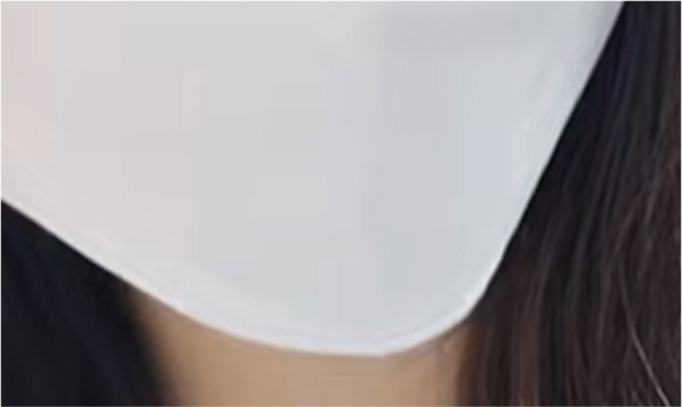 Double Eyelid Revision Surgery Review: You Must Be Careful with Extremely Difficult Eyes image 25