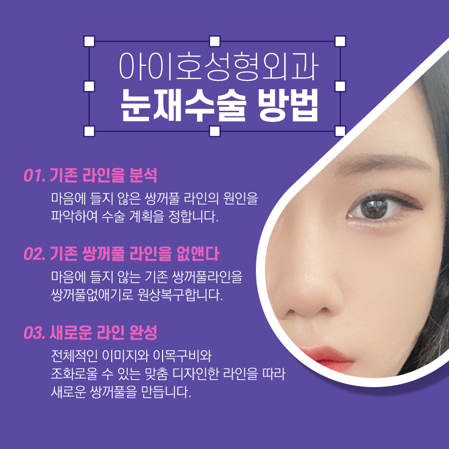 소세지눈 재수술 붓기 고민하지 않으려면 관련 이미지 3