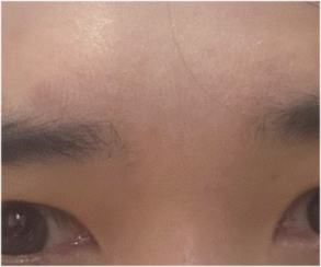 남자 눈매교정 가격 및 남자 눈매교정 전후 차이 비교 분석 관련 이미지 21