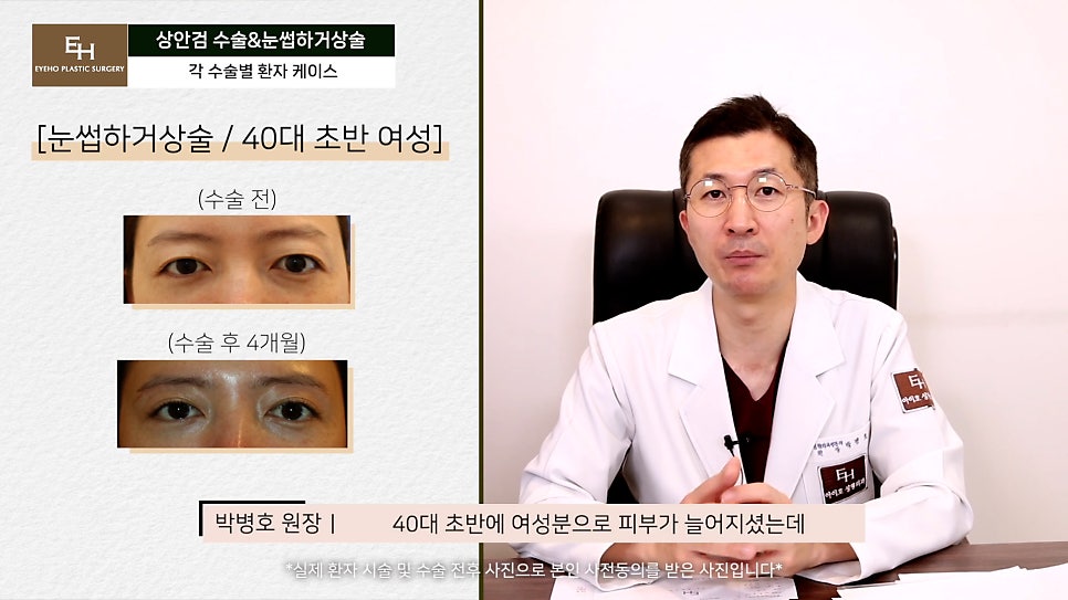 처진눈 상안검? 눈썹하거상술? 궁금하시다면 들어와!! 관련 이미지 33
