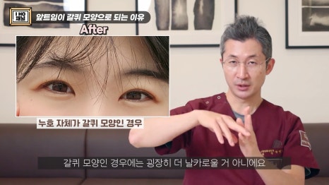 앞트임, 윗트임 하지 말아야할 눈!! 관련 이미지 42