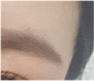 하안검 수술 후기 : 눈 밑 하안검 흉터 & 통증 / 잘하는곳 비교 분석 관련 이미지 22