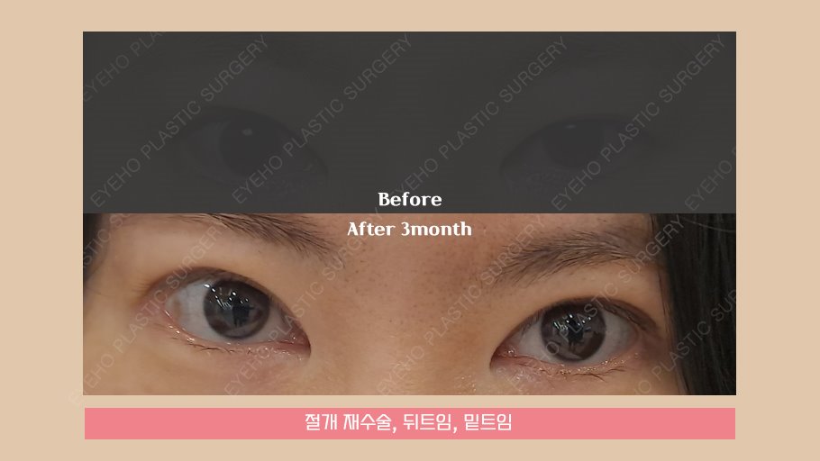 Because enough consultation is important for double eyelid incision revision surgery image 14