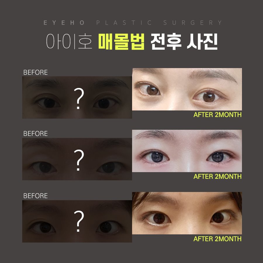 Double Eyelid Surgery Buried Suture Method Review: Double Eyelid Surgery Methods (Review, Cost, Types, Clinic) image 6