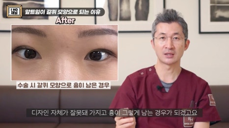 앞트임, 윗트임 하지 말아야할 눈!! 관련 이미지 45