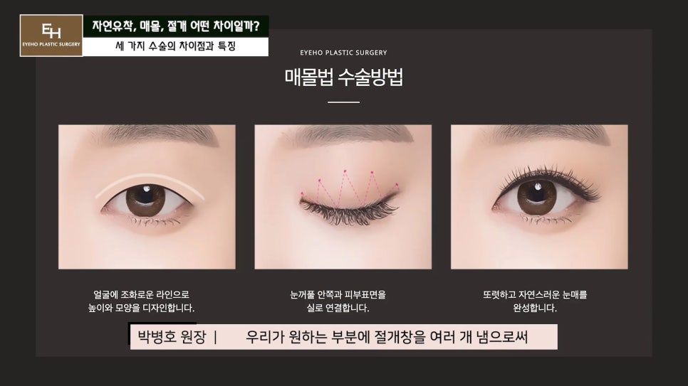 쌍수 자연유착 매몰 절개 차이점과 선택 기준 알려드릴게요. 관련 이미지 3