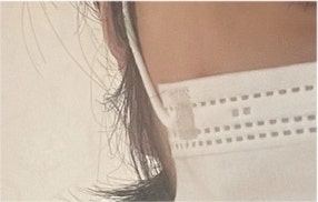 남자 눈매교정 가격 및 남자 눈매교정 전후 차이 비교 분석 관련 이미지 23