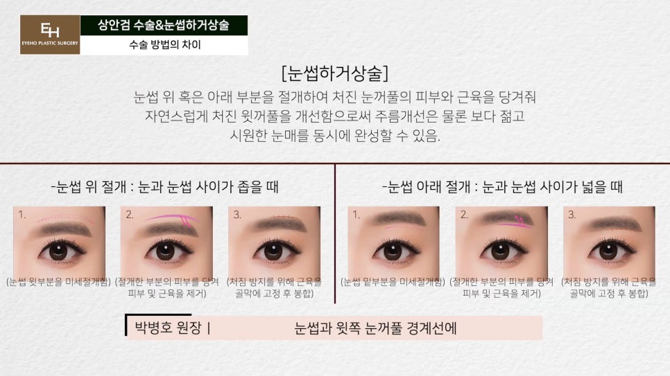처진눈 상안검? 눈썹하거상술? 궁금하시다면 들어와!! 관련 이미지 24