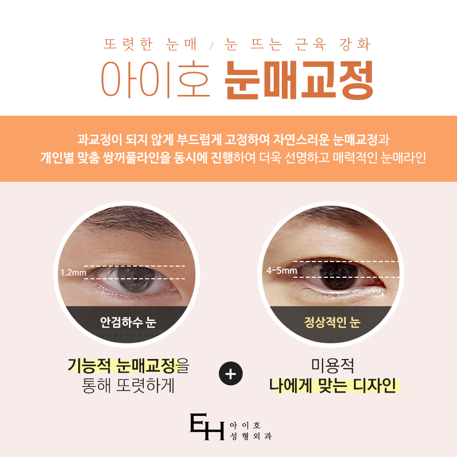 쌍꺼풀수술 가격 & 비절개 눈매교정 후기 (7일 경과) / 짝눈쌍수 관련 이미지 6