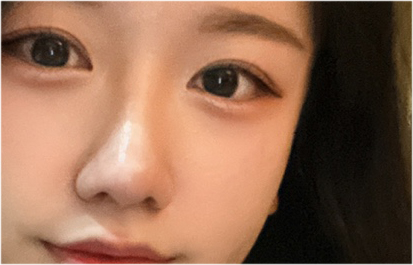 Comparing Incisional and Non-incisional Double Eyelid Surgery Before and After image 20
