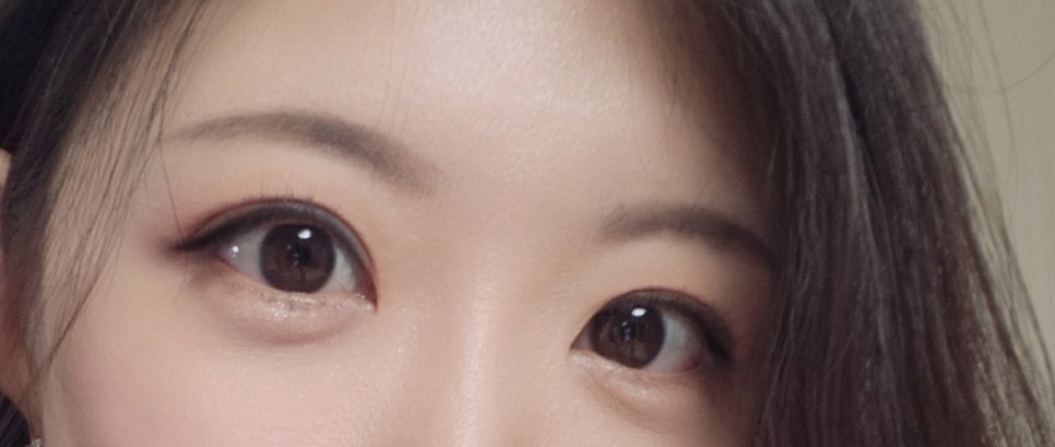 If You’re Considering Non-Incisional Eye Correction Surgery, Compare Reviews image 17