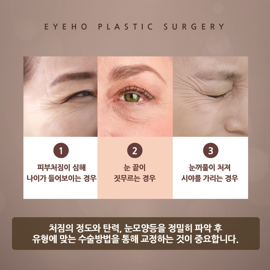 Upper Blepharoplasty for Drooping Eyes: Cost and Recovery Period image 4