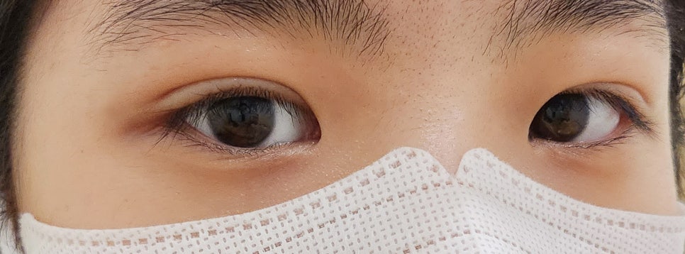 Satisfied Detail on Double Eyelid Revision Surgery Cost image 15