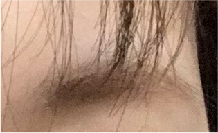 눈재수술비용 어떨때 개선해야 하나요? 관련 이미지 18