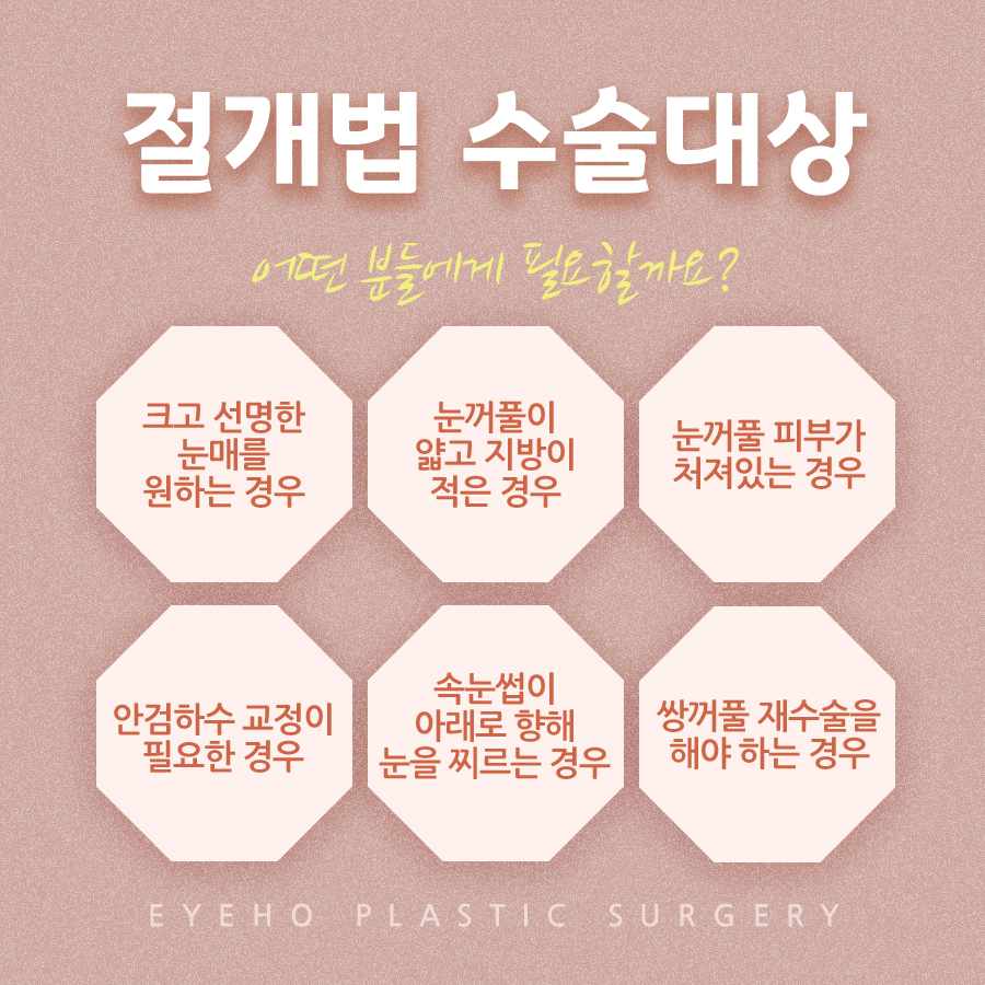 Natural Eye Line Before and After Double Eyelid Incision Surgery image 6