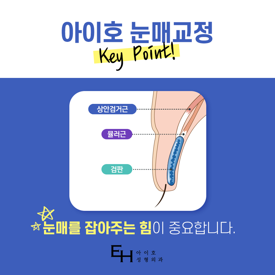 남자 눈매교정 가격 및 남자 눈매교정 전후 차이 비교 분석 관련 이미지 3
