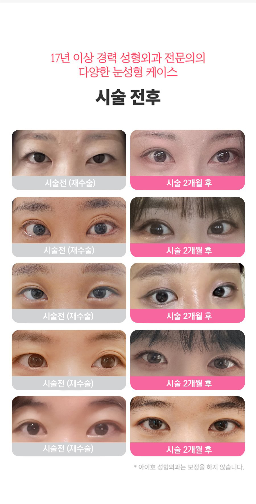 Double Eyelid Revision Surgery Review: You Must Be Careful with Extremely Difficult Eyes image 5